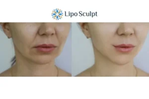 Explaining Total Skin Tightening Treatment And What It Can Do For You 2 Do you want to boost your self confidence? Give Morpheus8 Richmond upon Thames a try today!