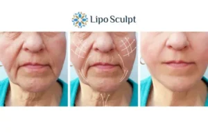 Explaining Total Skin Tightening Treatment And What It Can Do For You 3 Boost your confidence with Morpheus8 Richmond upon Thames call our team today!