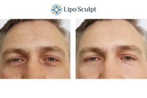 Explaining Total Skin Tightening Treatment And What It Can Do For You 6 Morpheus8 Richmond upon Thames book in today to find out more!