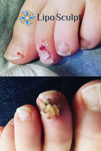 Wart removal customer results from Lipo Sculpt Richmond upon Thames